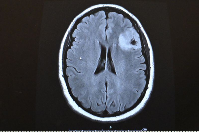An MRI taken days before surgery shows the brain tumor, a grade IV glioblastoma, for which Elishaba Doerksen is receiving chemo and radiation therapy. (Bill Roth / ADN)