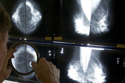 Mammograms should start at 40 to address rising breast cancer rates at younger ages, task force says